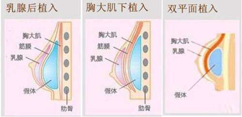 假体隆胸是*的吗?假体隆胸多少钱?需要取