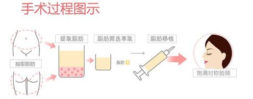 自体脂肪填充——锁住青春,留住岁月