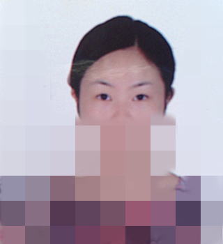 在成都天之美做的双眼皮,刘宁主刀,恢复情况