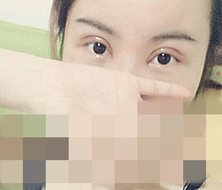 在成都天之美做的双眼皮,刘宁主刀,恢复情况
