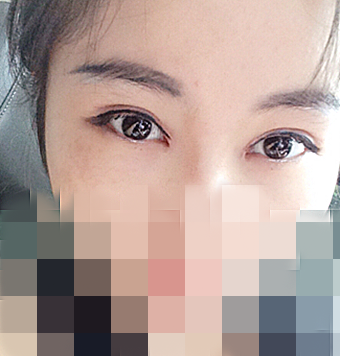 在成都天之美做的双眼皮,刘宁主刀,恢复情况