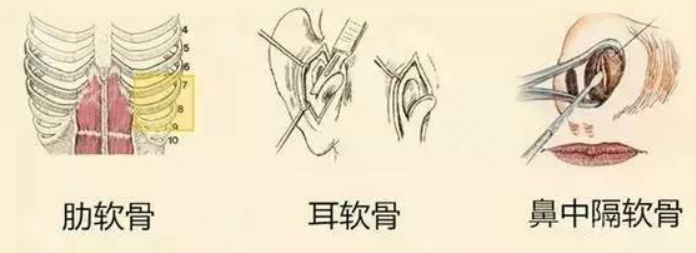 隆鼻材料你知多少?看看哪种适合你