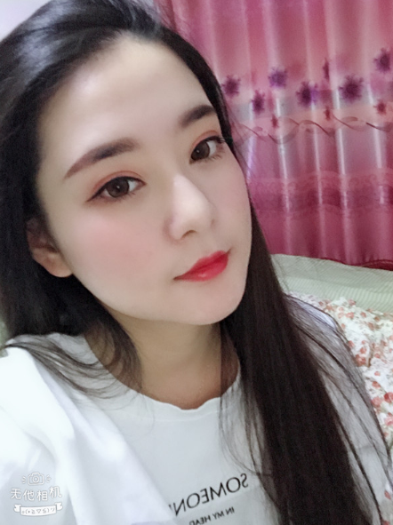 在上海首尔丽格做的磨骨,术后50天的*果