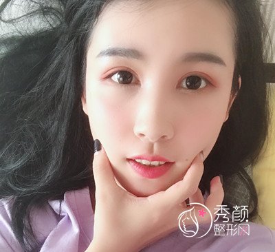 上海华美杨亚益割双眼皮开眼角恢复过程，7mm扇形真的很适合我！