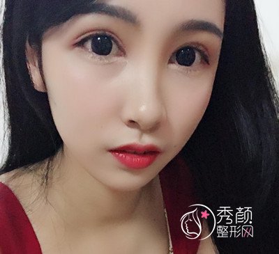 上海华美杨亚益割双眼皮开眼角恢复过程，7mm扇形真的很适合我！