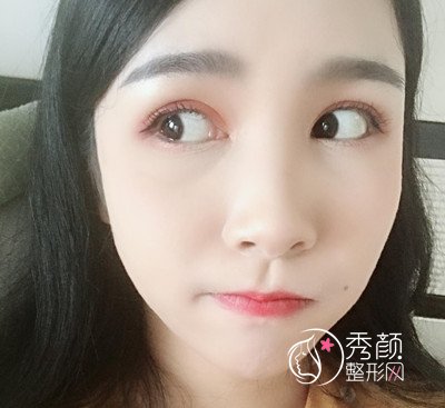 上海华美杨亚益割双眼皮开眼角恢复过程，7mm扇形真的很适合我！