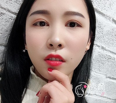 上海华美杨亚益割双眼皮开眼角恢复过程，7mm扇形真的很适合我！