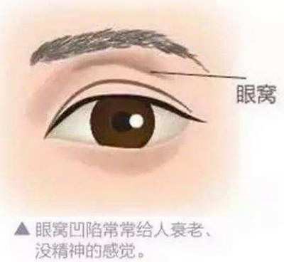 北京燕郊割双眼皮手术后有什么注意事项？
