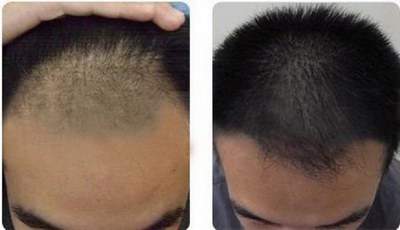半永久发际线后可以维持多久的时间