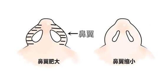 什么就鼻翼缩小手术 济南集美医院张冠勋 打造精致小翘鼻