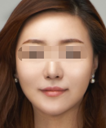 面部提升抗初老案例公开，济南韩美整形美容医院姜春声提升效果图。