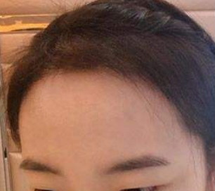 广州雍禾植发做发际线种植好不好？术前术后对比图公开