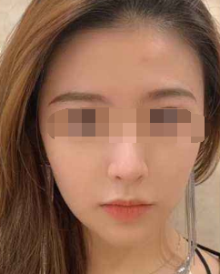 歪鼻矫正术后照片来了，聊城韩美整形美容医院整形案例！