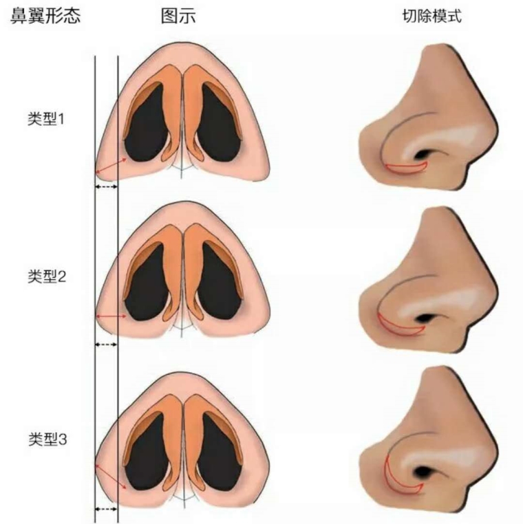 过来人说说鼻孔缩小手术价格多少钱