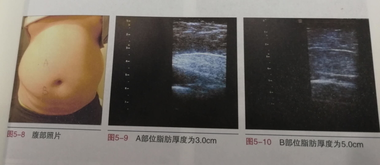 大神详解手臂吸脂价格是多少？