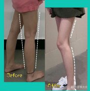 专家亲自说说重庆做腿部减肥抽脂价格多少钱