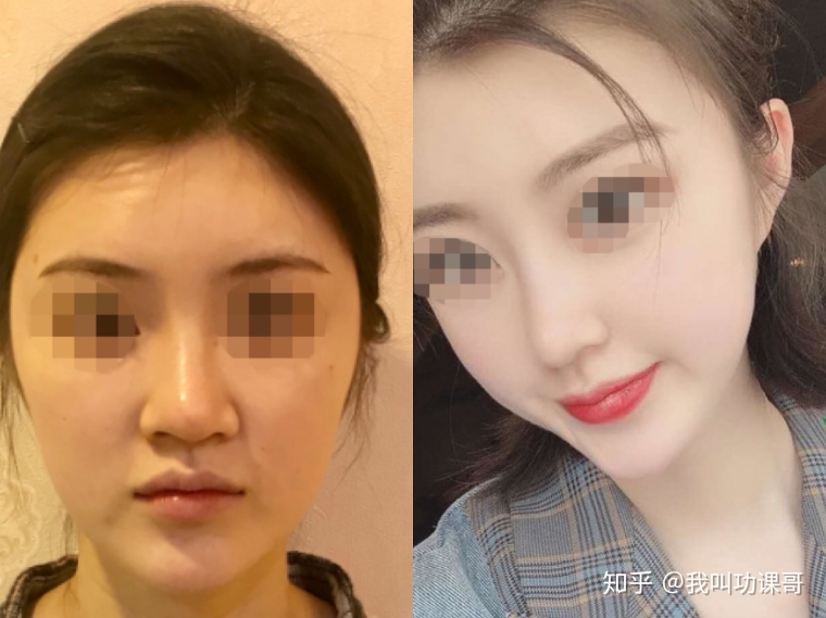 美容师说说广州假体隆鼻手术会有年龄限制吗
