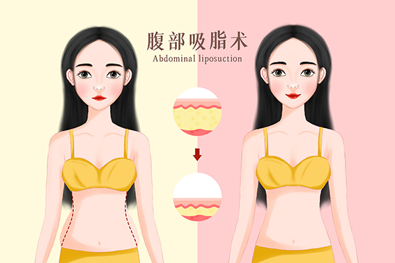 摄图网_401862924_banner_美容整形之腹部抽脂插画（非企业商用）.jpg