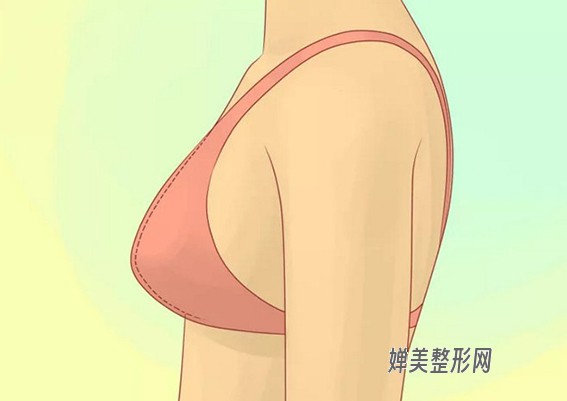 乳房下垂矫正方法有哪些？乳房下垂矫正术效果好吗？
