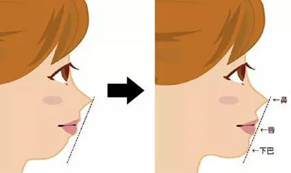 隆鼻的方法有哪些？隆鼻后多久能恢复？