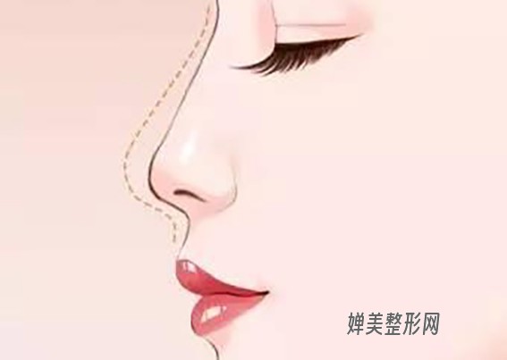 韩式综合隆鼻要多少费用？韩式综合隆鼻效果怎么样？