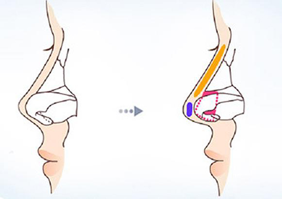 延长鼻小柱的方法有哪些？鼻小柱延长效果好不好？