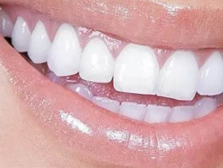 烤瓷牙的使用寿命是多久 深圳贝臣口腔门诊部专注牙科整形