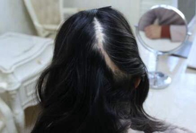 疤痕植发什么时候做 武汉五洲植发做疤痕植发多少钱