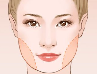 面部吸脂的适合年龄 长沙艾依美整形医院多层瘦脸 气质小V