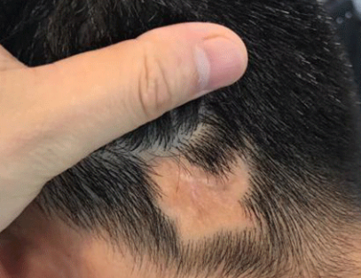 重庆疤痕植发多少钱 雍禾植发疤痕植发后多久能长出头发