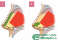 朝天鼻怎么做手术