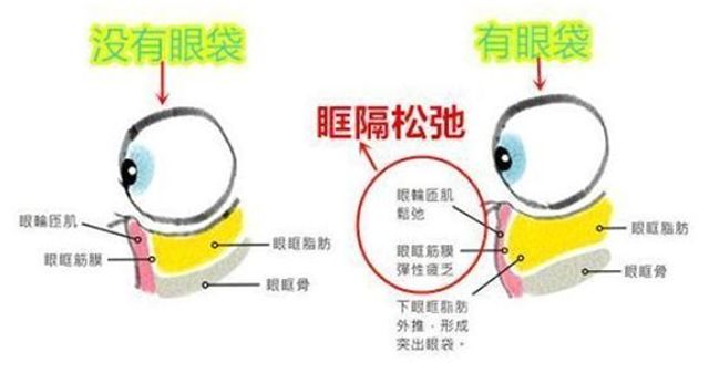 有了显老眼袋和泪沟，该怎么解决?