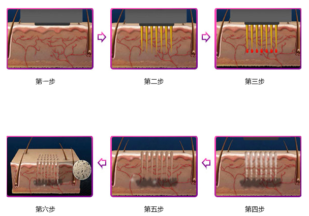 复合彩光嫩肤怎么样