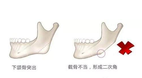 北京圣嘉新张立天：下颌角整形失败后怎样修复?