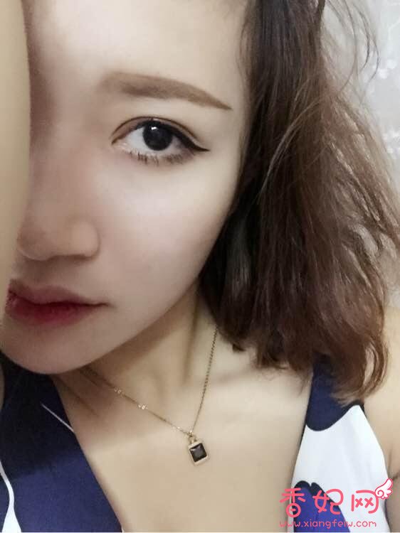 韩式三点整形案例分享重庆哪家医院做双眼皮手术好