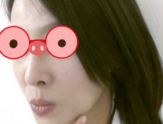 电波拉皮治疗过程分享