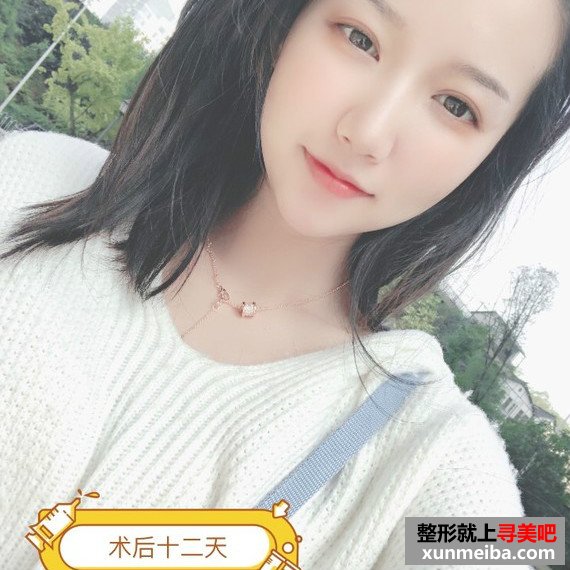 长沙美容院自体脂肪面部填充和假体丰下巴整形日记 长沙美容院自体脂肪面部填充和假体丰下巴整形日记