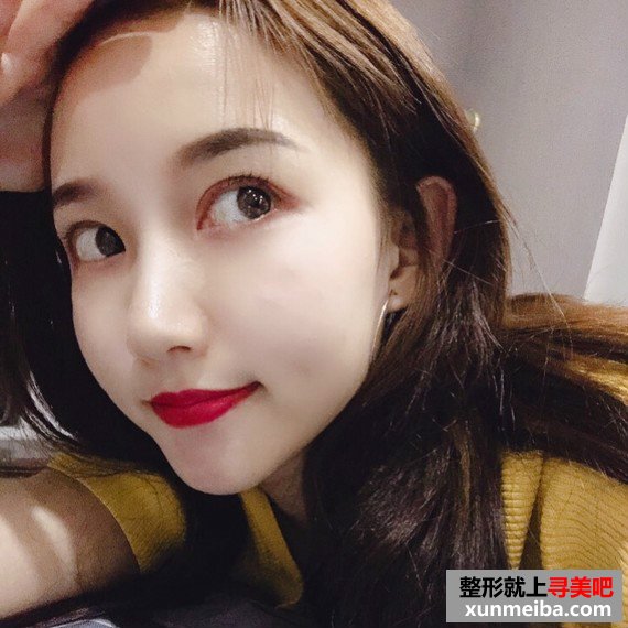 长沙美容院自体脂肪面部填充和假体丰下巴整形日记 长沙美容院自体脂肪面部填充和假体丰下巴整形日记