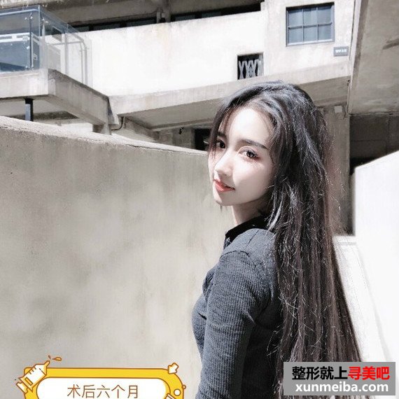 长沙美容院自体脂肪面部填充和假体丰下巴整形日记 长沙美容院自体脂肪面部填充和假体丰下巴整形日记