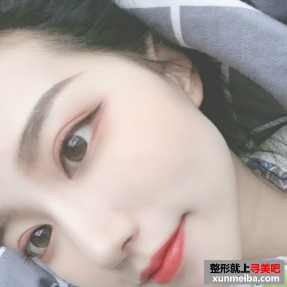长沙美容院自体脂肪面部填充和假体丰下巴整形日记 长沙美容院自体脂肪面部填充和假体丰下巴整形日记