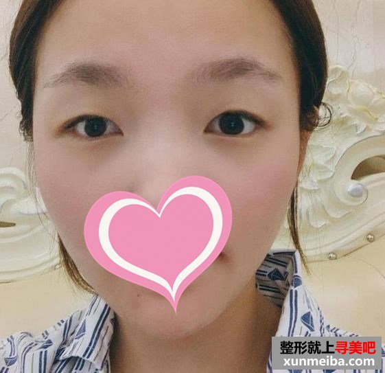 上海安缦医疗美容门诊割双眼皮案例术前